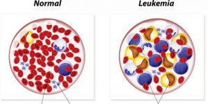 6 tanda Leukemia yang harus Anda ketahui